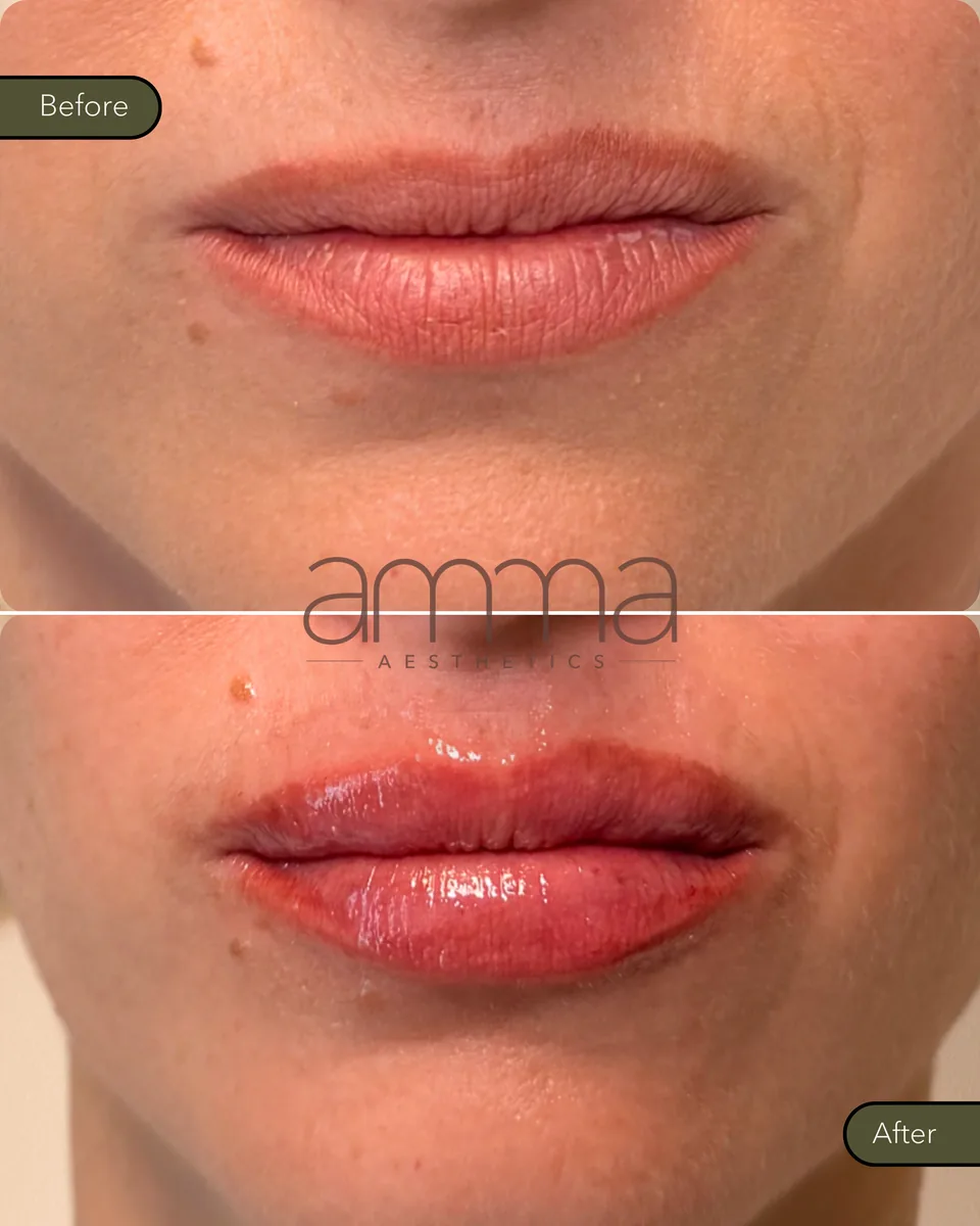 Lip filler before and after at AMMA Aesthetics in South Miami