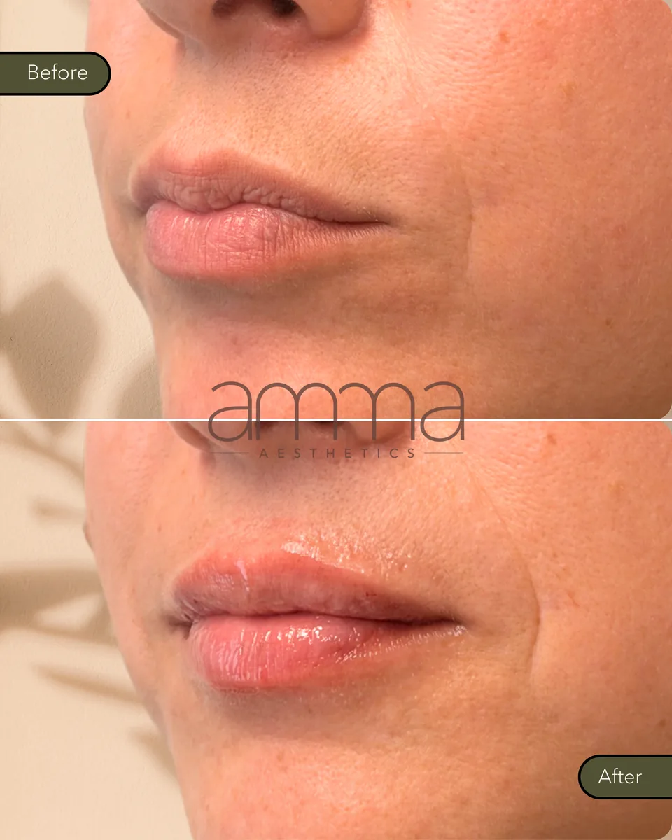 Lip filler before and after, side view, at AMMA Aesthetics in South Miami