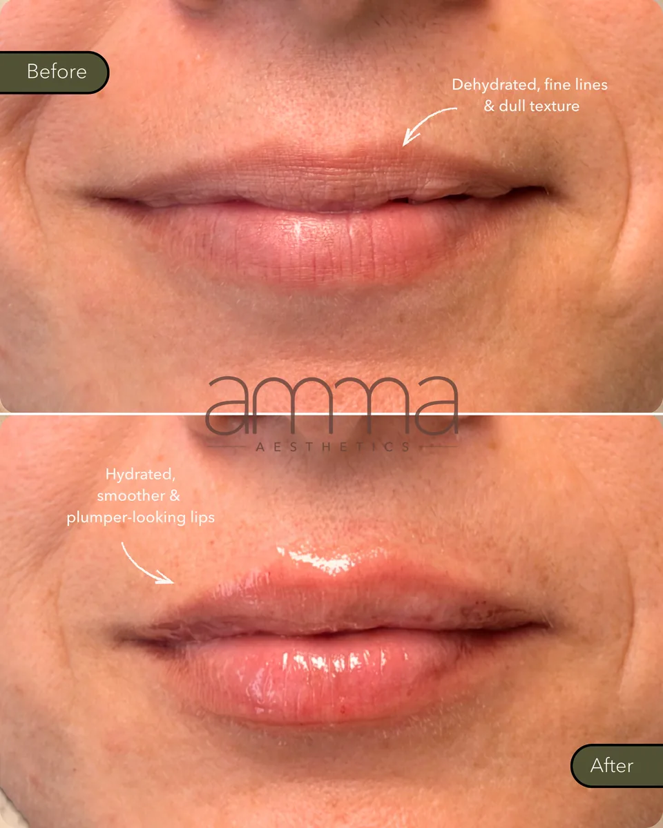 Lip filler before and after showing hydrated, fuller lips at AMMA Aesthetics in South Miami