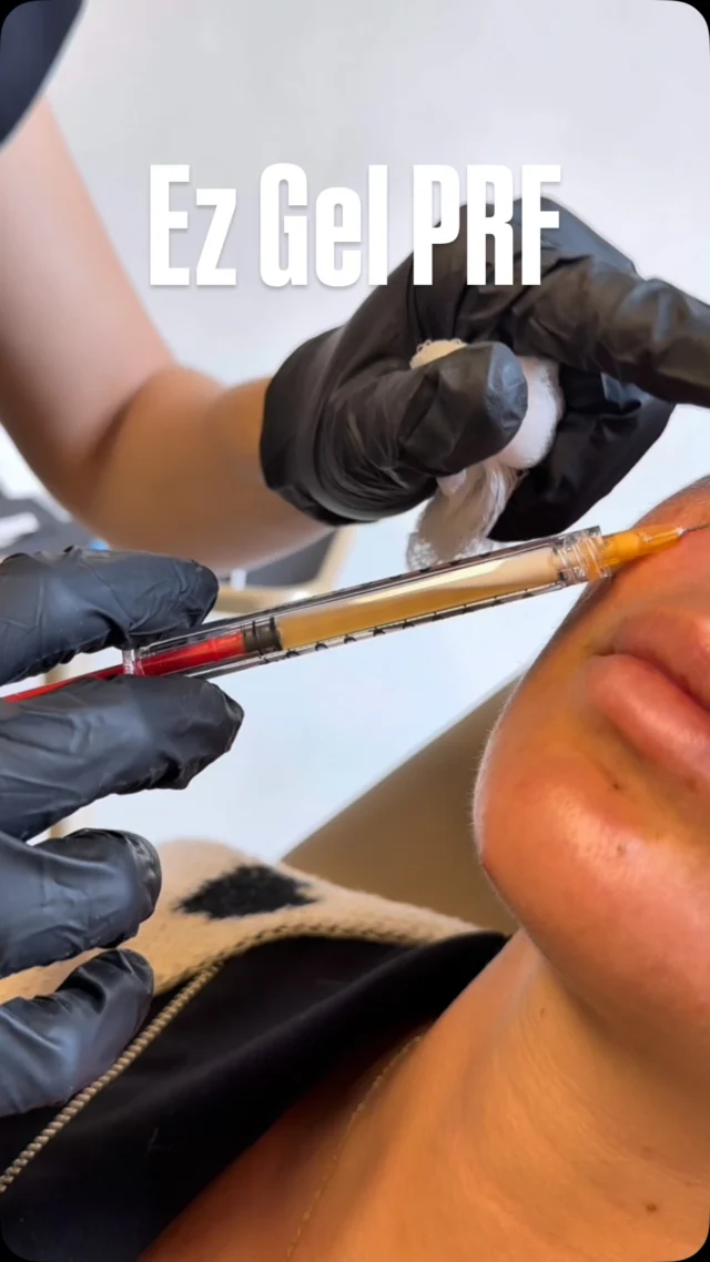 #EzGel PRF by @skinwithsophh at Amma! 

Your body can make its own #filler. 🩸✨

No synthetic anything. No foreign substances. Just you. 💛

Our NP is breaking down EZ Gel #PRF — what it really is, how the treatment works, and why everyone’s obsessed. 👀

You’re going to want to see this one. 👇

BOOK NOW ⬇️
📲 Call/Text: (786) 558-4239
💬 DM us on Instagram
📆 Book through the link in our bio