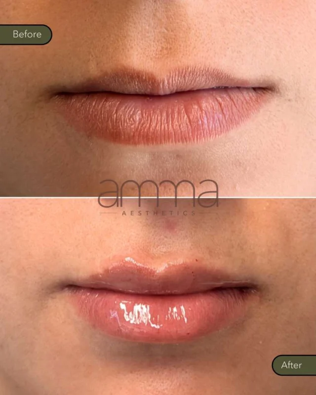 💋 Subtle. Hydrated. Naturally YOU.

Swipe to see the difference a little artistry makes ✨ These #lips weren’t overfilled, they were enhanced. Soft volume, balanced shape, and that healthy glossy finish that turns heads without screaming “filler.” 👀

The secret? It’s all about technique. We don’t chase trends—> we sculpt to your anatomy for a result that looks like you woke up like this. 😍

¿Lista para tus labios soñados? They’re closer than you think. 💄

BOOK NOW ⬇️
📲 Call/Text: (786) 558-4239
💬 DM us on Instagram
📆 Book through the link in our bio

#AmmaAesthetics #LipFiller #MiamiMedSpa