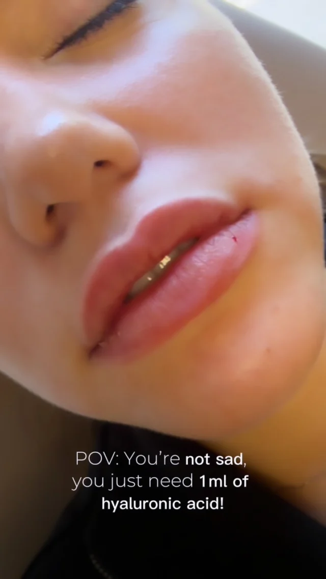 POV: You’re not sad… you’re just 1 ml away from your villain-era glow 💉💋

Okay but real talk, there’s something about walking out with the #PerfectLips💋that hits different. Not overdone. Not duck. Just #balancedLips, #hydrated, naturally-you-but-better volume that has you catching yourself in every reflection 👀✨

1ml of hyaluronic acid + the right injector = the kind of result that does the talking for you. Soft, kissable, and customized to your face -> never a one-size-fits-all situation. 💉

BOOK NOW ⬇️
📲 Call/WhatsApp: (786) 558-4239
💬 DM us on Instagram
📆 Book through the link in our bio

#AmmaAesthetics #MiamiMedSpa