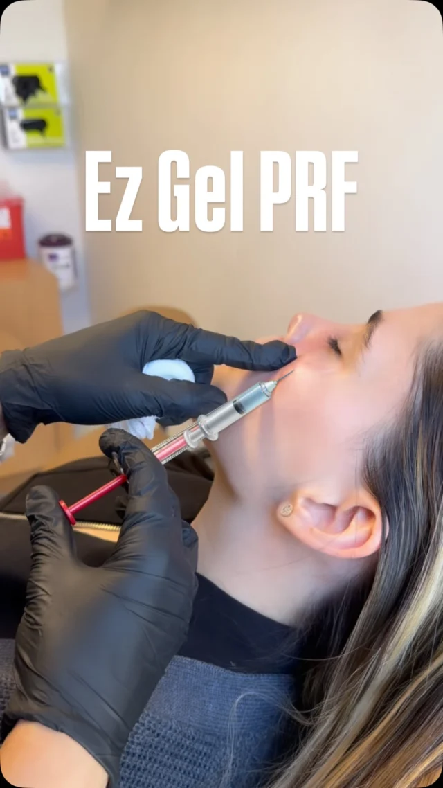 ✨ We all have the same doubts…

What’s the difference between #PRPvsPRF? Why do some providers treat the under-eyes with tiny injections while others use a cannula? And which approach is best for you?

During this #EzGel treatment, we put our provider on the spot and asked the questions we hear most often from our patients. 👀

Watch the video to learn the key differences, understand the benefits of each technique, and discover why personalized treatment plans matter when it comes to achieving natural, refreshed results.

Have more questions about #UnderEyeRejuvenation? We’re here to help.

BOOK NOW ⬇️
📲 Call/Text: (786) 558-4239
💬 DM us on Instagram
📆 Book through the link in our bio

#PRFUnderEyes #MiamiMedSpa
