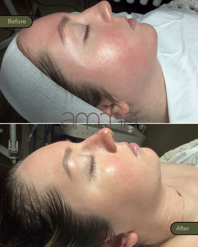 ✨ #Rosacea doesn’t mean you can’t have glowing, healthy-looking skin. It just needs the right approach.

This beautiful before & after is the result of our #AMMASignatureFacial, combined with #LEDLightTherapy and #medical-gradeSkincare customized for this patient’s skin.

Our patient has rosacea, and the goal of this treatment was to calm inflammation, reduce visible redness, strengthen the skin barrier, and deeply hydrate the skin, all without causing irritation.

The result? A calmer complexion, a healthier glow, and skin that looks and feels refreshed. 💛

If you struggle with rosacea, #redness, or sensitive skin, remember: not every facial is created equal. A customized treatment can make all the difference.

✨ Let us help you find the right skincare plan for your skin.

BOOK NOW ⬇️
📲 Call/WhatsApp: (786) 558-4239
💬 DM us on Instagram
📆 Book through the link in our bio