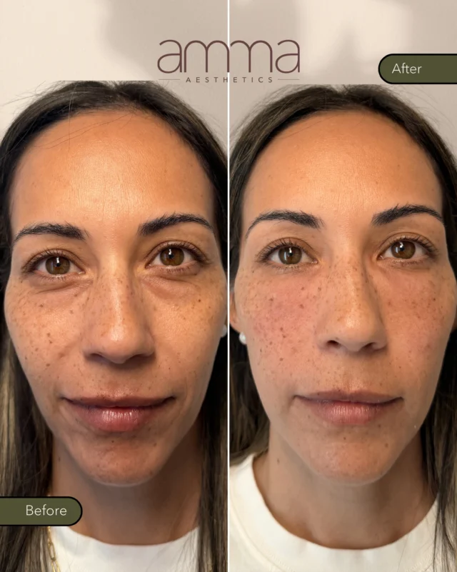 Before & After ✨ EZ Gel | Under Eyes + Nasolabial Folds

Sometimes the most beautiful results are the ones that don’t look “done”, they simply look refreshed. 💛

This transformation was achieved with #EzGel, a regenerative treatment made from your body’s own natural #GrowthFactors. By stimulating #collagen production, it helps restore volume, soften fine lines, and improve skin quality over time.

In this case, we treated:
✨ #UnderEye hollows
✨ #Nasolabial folds

The result? A brighter, smoother, and naturally rejuvenated appearance—without looking overfilled.

Ready to discover if EZ Gel is right for you?

📲 Call/WhatsApp: (786) 558-4239
💬 DM us on Instagram
📅 Book through the link in our bio