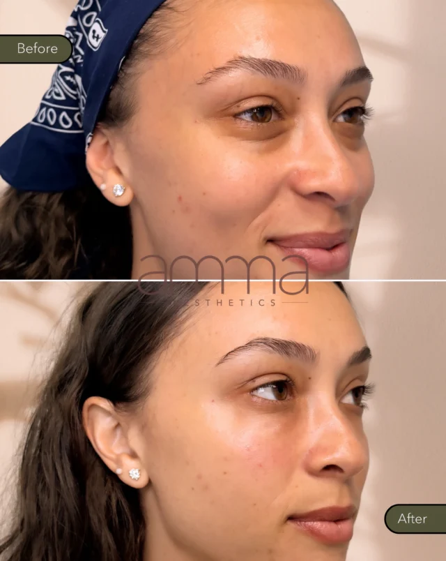 Your eyes can say “well-rested” again… naturally. 🤍

Swipe to see the transformation. 👉

This beautiful result was achieved with EZ Gel (1 session, 2 more to go), a regenerative treatment that uses your body’s own growth factors to stimulate collagen, improve skin quality, and restore a refreshed appearance, without looking overdone.

Notice how the under-eye area appears:
✨ Brighter
✨ Smoother
✨ More hydrated
✨ Naturally refreshed

EZ Gel is one of our favorite treatments for patients who want subtle, elegant rejuvenation while improving the skin from within.

Every treatment is personalized because no two faces (and no two under-eyes) are the same.

Ready to refresh your eyes naturally?

BOOK NOW! 
📲 Call/WhatsApp: (786) 558-4239
💬 DM us on Instagram 
📅 Book through the link in our bio

#EzGel #UnderEyeTreatment #CollagenStimulation #NaturalAesthetics #AmmaAesthetics