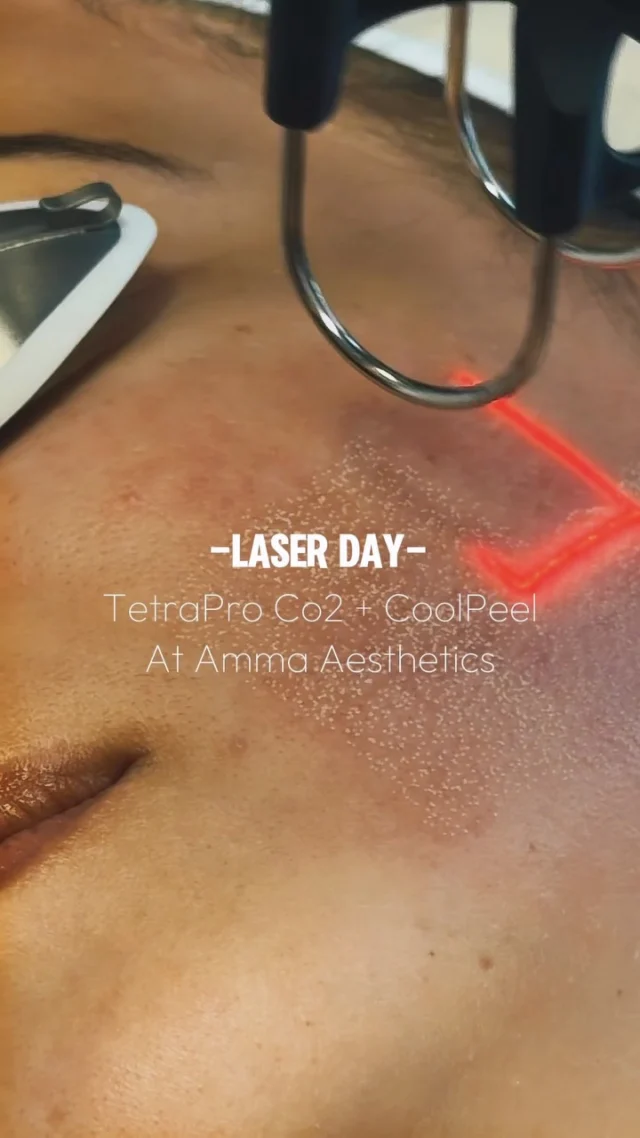 ✨ CO2 Laser Day at Amma Aesthetics ✨

All day, every glow-up! 💫 We’re pairing TetraPro CO2 + CoolPeel Laser to resurface, tighten, and refresh your skin from the inside out.

🔬 TetraPro CO2 stimulates deep collagen to smooth fine lines, scars & texture — while CoolPeel delivers all the power of CO2 with virtually NO downtime. Brighter, tighter, younger-looking skin without hitting pause on your life. 😍

🔥 LAUNCH PRICING — only until Aug 31st!
Be one of the first to experience these game-changing treatments at our special introductory rates. Don’t wait — these prices won’t last! ⏳

Book now before this offer is gone! 👇

BOOK NOW
📲 Call/WhatsApp: (786) 558-4239
💬 DM us on Instagram
📅 Book through the link in our bio

#AmmaAesthetics #CoolPeel #CO2Laser #SkinResurfacing #GlowUp