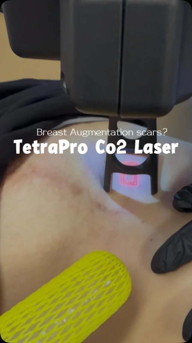 Breast augmentation can be life-changing—but your scar doesn’t have to be a permanent reminder.

Our TetraPro CO₂ laser helps improve the appearance of surgical scars by resurfacing the skin and stimulating collagen production, revealing smoother, healthier-looking skin over time. ✨

Every scar is unique, which is why we create a personalized treatment plan based on your skin and goals.

Ready to feel more confident in your skin?

BOOK NOW
📲 Call/WhatsApp: (786) 558-4239
💬 DM us on Instagram
📅 Book through the link in our bio

#ScarRevision #BreastAugmentation #CO2Laser #TetraPro #AmmaAesthetics