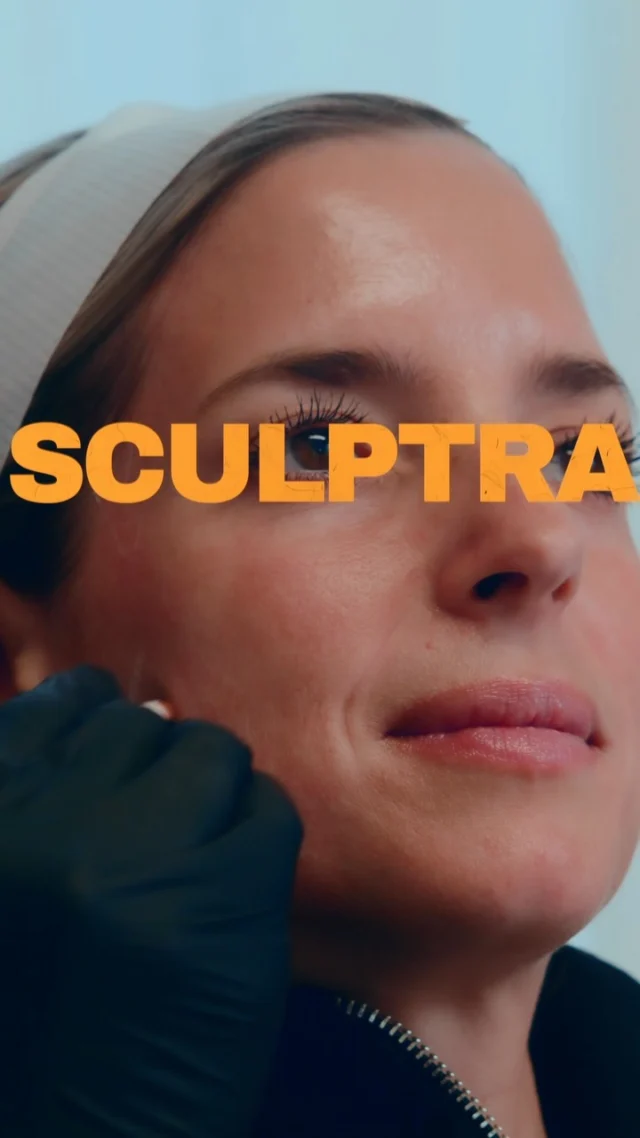 This is Patty just 2 WEEKS after her Sculptra treatment… and it’s only the beginning 😍💉

You watched the FULL treatment step by step with Sophie… today you get to see the first glimpse of results. 

Look at that lift. Look at that GLOW ✨ And here’s the wild part: this is the EARLIEST stage. Sculptra works by stimulating your own collagen, so your body keeps building for the next 3–6 months. These results don’t fade… they get BETTER. 📈

No filler look. No overdone anything. Just YOU, gradually restored, and we’re only at week 2. 💖

👉 Missed part 1? Go back and watch the full 8-part treatment video to see exactly what the process looks like from start to finish!

Stay tuned! we’ll keep sharing Patty’s progress as the collagen builds 👀

Ready to start your own Sculptra journey? Let’s get you on the schedule 💫

BOOK NOW
📲 Call/WhatsApp: (786) 558-4239
💬 DM us on Instagram
📅 Book through the link in our bio

#Sculptra #AmmaAesthetics #TwoWeeksPost #CollagenBoost #NaturalResults