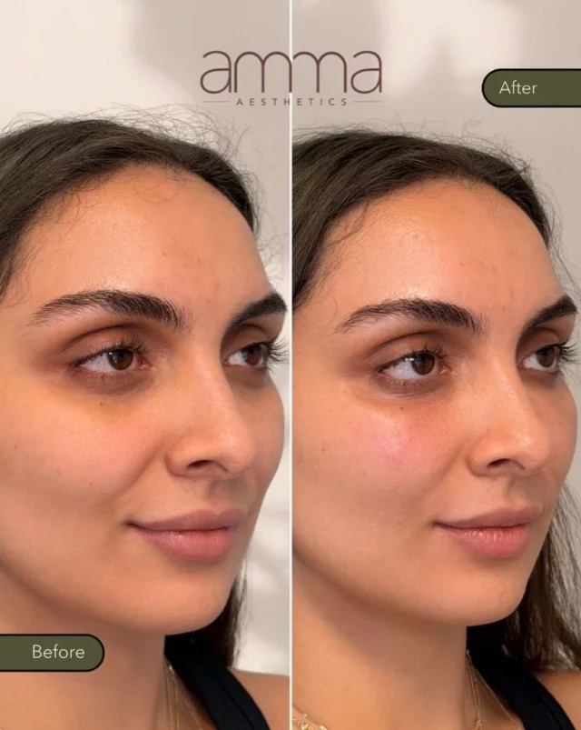 Your body. Your collagen. Your glow. ✨

This is after just one EZ Gel treatment.

Swipe through the before and after to notice the difference:
• Brighter, more refreshed under eyes
• Softer appearance of the nasolabial folds
• Improved skin quality and hydration
• A naturally rested look... without looking overfilled

EZ Gel is a regenerative treatment made from your own blood, rich in growth factors and fibrin that stimulate your body’s natural collagen production. Rather than simply adding volume, it helps your skin regenerate from within.

And the best part? These are just the beginning. As collagen continues to build over the next several weeks, results continue to improve.

Ready for a natural refresh?

BOOK NOW
📲 Call/WhatsApp: (786) 558-4239
💬 DM us on Instagram
📅 Book through the link in our bio

#EZGel #RegenerativeAesthetics #UnderEyeRejuvenation #CollagenStimulation #AmmaAesthetics