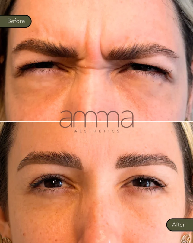 Oh that Smoothness! ✨

A little before & after magic with Dysport®, softening dynamic lines while keeping the result natural, balanced, and still you.

Notice the difference:
✨ Smoother forehead lines
✨ Softer frown lines between the brows
✨ A more relaxed, refreshed expression
✨ Natural movement, just beautifully softened

Because the best injectable results shouldn’t change your face, they should simply make you look like your most rested self. 🤍

Ready for your refresh?

BOOK NOW
📲 Call/WhatsApp: (786) 558-4239
💬 DM us on Instagram
📅 Book through the link in our bio

#BotoxBeforeAndAfter #DysportMiami #NaturalBotox #InjectablesMiami SouthMiamiMedSpa AmmaAesthetics
