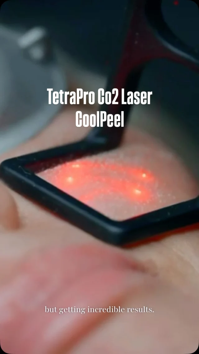 Introducing the future of skin resurfacing. ✨

Meet the DEKA TetraPro CO₂ Laser, the newest addition to Amma Aesthetics, presented by our Nurse Practitioner, Sophie.

This advanced fractional CO₂ laser delivers dramatic skin rejuvenation by improving fine lines, wrinkles, acne scars, sun damage, uneven texture, and overall skin quality.

And here’s what makes it even more exciting for Miami... ☀️

With CoolPeel®️, you can enjoy the benefits of traditional CO₂ resurfacing with significantly less downtime, less redness, and a faster recovery, making it a perfect option for year-round treatments, even with our sunny lifestyle.

Ready to reveal smoother, healthier, more radiant skin?

✨ LAUNCHING SPECIAL: 20% OFF TetraPro CO₂ & CoolPeel treatments through August 31st!

BOOK NOW
📲 Call/WhatsApp: (786) 558-4239
💬 DM us on Instagram
📅 Book through the link in our bio

#CoolPeel #TetraPro #CO2Laser #SkinResurfacing #AmmaAesthetics