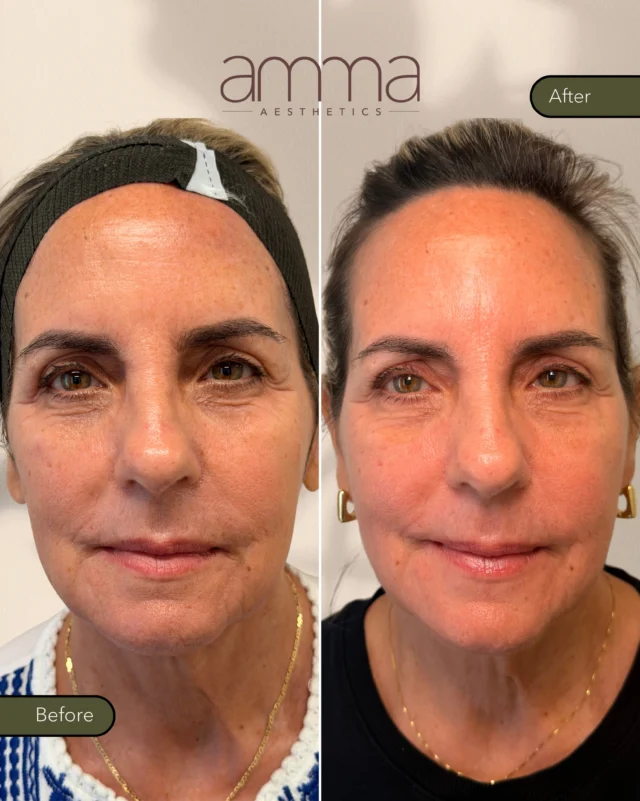 4 weeks post Tetra PRO Fractional CO₂ ✨

And the skin is already speaking for itself. 🤍

After just one Tetra PRO Fractional CO₂ treatment, we’re seeing beautiful improvement in overall skin quality: smoother texture, softened fine lines, more even tone, and a fresher, firmer-looking complexion.

The best part? Collagen remodeling doesn’t stop here. Fractional CO₂ stimulates the skin’s natural renewal process, so results can continue to develop over the next several months.

This is what we love about regenerative aesthetics: not changing your features, just helping your skin look healthier, smoother, and refreshed. ✨

BOOK NOW
📲 Call/WhatsApp: (786) 558-4239
💬 DM us on Instagram
📅 Book through the link in our bio