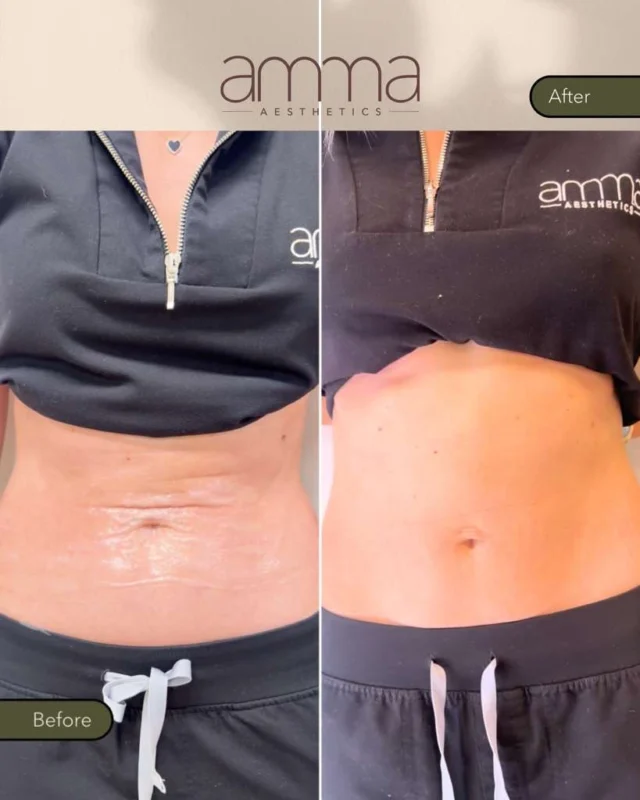Yeap… that’s me, Patty. 👀✨ 4 months after my first treatment.

After 2 pregnancies, weight loss, and a lot of skin laxity, I decided to try Everesse Monopolar RF, a non-invasive treatment designed to tighten the skin, improve laxity, and stimulate collagen for a smoother, firmer appearance.

And I am LOVING the improvement in my abdominal area! 🤍 Tighter-looking skin, smoother texture, and an overall more refined appearance, without surgery or downtime.

And the best part? Collagen remodeling continues over time, which means results can keep improving in the months following treatment. ✨

Ready to see what Everesse can do for you?

BOOK NOW
📲 Call/WhatsApp: (786) 558-4239
💬 DM us on Instagram
📅 Book through the link in our bio

Individual results may vary.

#Everesse #MonopolarRF #SkinTightening #BodyTightening #CollagenStimulation AmmaAesthetics MiamiMedSpa