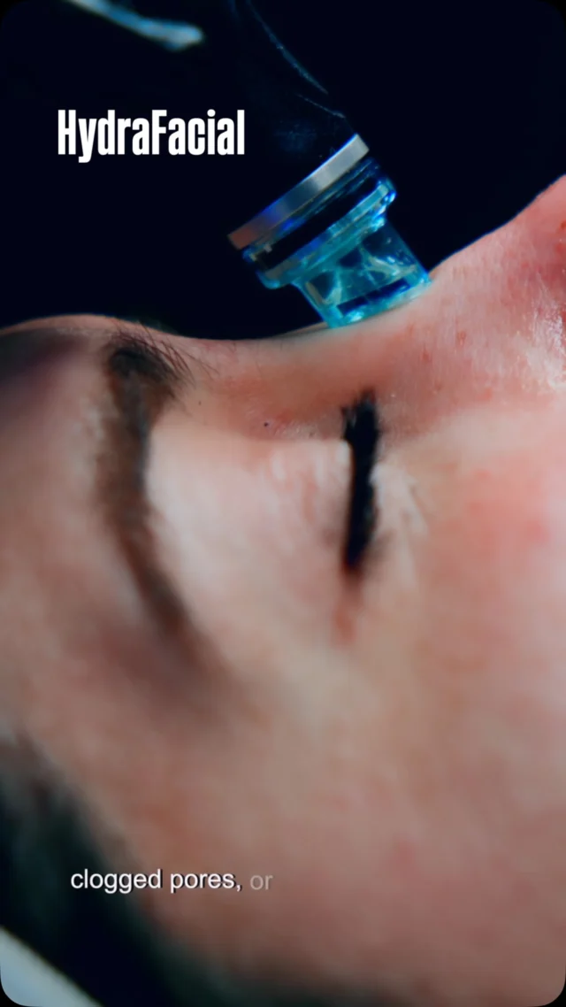 POV: you finally booked the HydraFacial everyone keeps talking about… and now you can’t stop looking at your skin. 👀✨

Clean pores. 💦
Deep hydration.
Glass-skin GLOW. ✨
Zero downtime.

Consider this your sign to stop saying “I need a facial” and actually book it. 😂

BOOK NOW: 
📲 Call/WhatsApp: (786) 558-4239
💬 DM us on Instagram
📅 Book through the link in our bio

Your glow is one appointment away. 🤍

#HydraFacialMiami #HydraFacial #MiamiMedSpa #SouthMiami #AmmaAesthetics