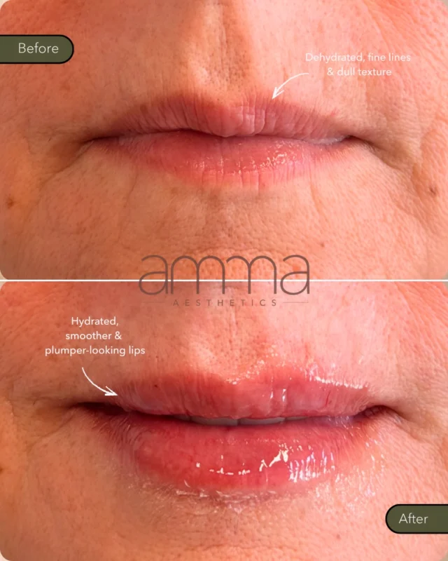 She waited YEARS for this moment… and it was worth the wait. 🥹💋✨

In her 60s, this beautiful patient had always wanted lip filler to restore hydration and subtly enhance her lips… but she was afraid of looking “overdone.”

Then she trusted Amma. 🤍

Her goal was simple: natural, hydrated, soft, plump-looking lips that still felt like HER. And this result is exactly that.

No dramatic transformation. No “filler look.” Just a beautiful, refreshed version of her natural lips. ✨

Because lip filler isn’t about age, and it doesn’t have to mean bigger. Sometimes it’s simply about restoring what time has changed while keeping you looking like YOU.

We’re obsessed with this result. 🫶🏻

BOOK NOW!
📲 Call/WhatsApp: (786) 558-4239
💬 DM us on Instagram
📅 Book through the link in our bio

Individual results may vary.

#LipFiller #NaturalLipFiller #MatureLips #LipEnhancement #LipRejuvenation