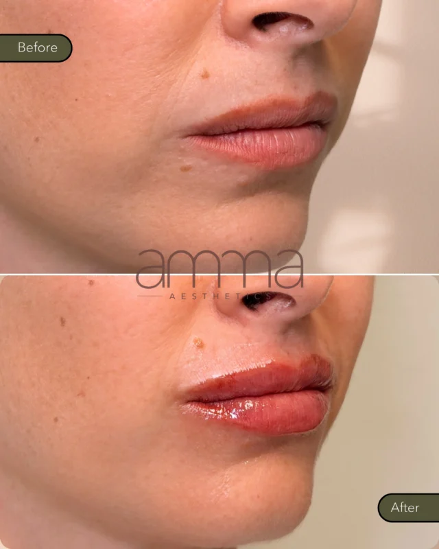 A little enhancement, a BIG difference. 💋

Soft, balanced, plum & beautiful... this lip transformation is all about enhancing her natural shape while adding the perfect touch of volume and definition.

Because lip filler doesn’t have to look “done.” The goal is for you to still look like YOU… just a little juicier. 🤍

Natural. Refined. AMMA.

BOOK NOW
📲 Call/WhatsApp: (786) 558-4239
💬 DM us on Instagram
📅 Book through the link in our bio

#LipFiller #LipEnhancement #NaturalLipFiller #BeforeAndAfter #MiamiMedSpa